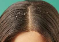 احذري من هذه الحيلة للتخلص من قشرة الشعر.. قد تسبب لك جراح وآلام خطيرة