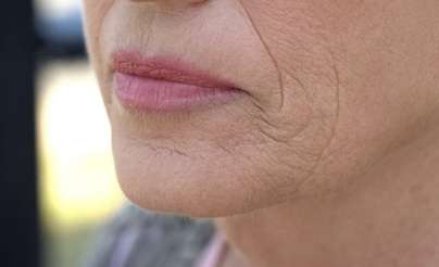 علاج طبيعي لإزالة التجاعيد من منطقة حول الفم