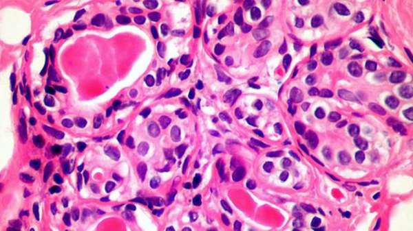 الأسلوب الجديد قد يقتل أنواعا كثيرة من الخلايا السرطانية، بما فيها الثدي والبروستات