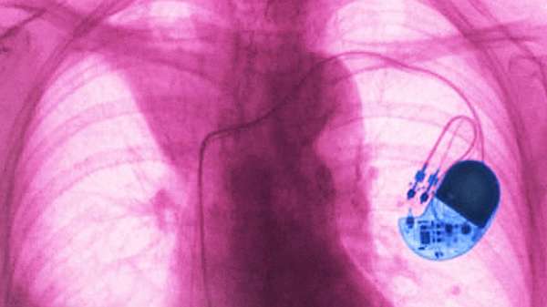 ثمة آمال في أن تؤدي أجهزة تنظيم ضربات القلب مهامَ أكثر بكثير من مجرد ضمان أن ينبض قلبك بشكل سليم