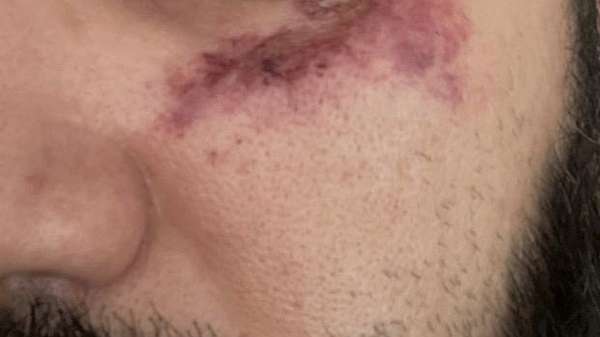 أحد المعتقلين والكدمات تظهر على وجهه