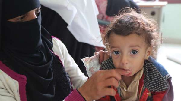 طفل بعمر 14 شهرا يعاني من سوء التغذية يتلقى علاجا في عياردة مدينة عمران باليمن